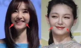 明星爆料打肉毒素视频,真实打肉毒素过程大公开