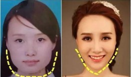 明星爆料打肉毒素视频,真实打肉毒素过程大公开